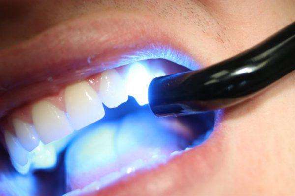 Лазерне, безпечне відбілювання зубів: плюси і мінуси