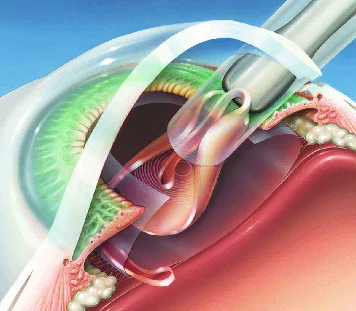 Что нужно знать о факоэмульсификации катаракты?