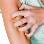 Аллергия на коже - причины, симптомы и методы лечения
