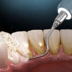 Чистка зубов ультразвуком: почему это важно?